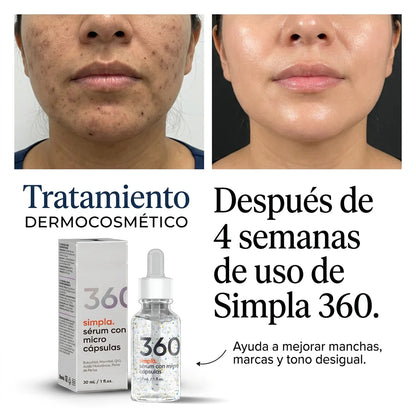 ¿Manchas, marcas de acné o cicatrices que no desaparecen?